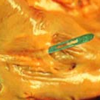 Vorhofseptumdefekt (ASD) und Offenes Foramen ovale (PFO) 