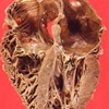 Herzmuskel-Krankheiten (Kardiomyopathien) 