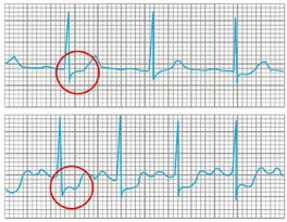 Belastungs-EKG (Ergometrie) 